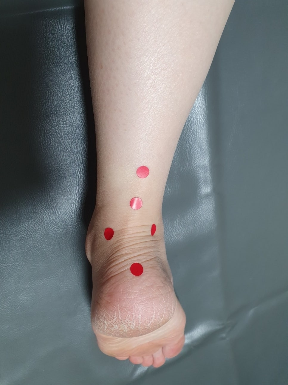 아킬레스 건염004