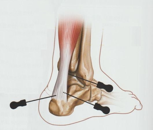 아킬레스 건염005