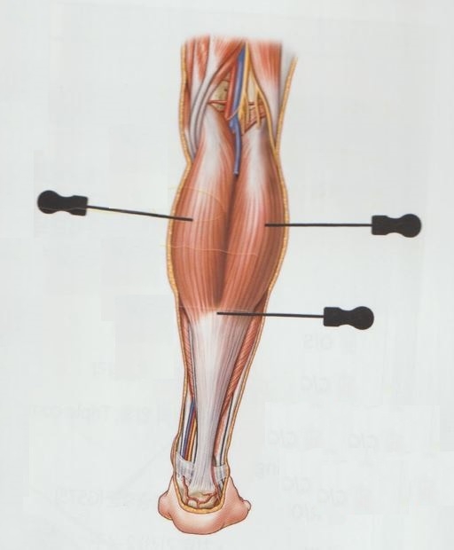 아킬레스 건염 8 아킬레스 건염007