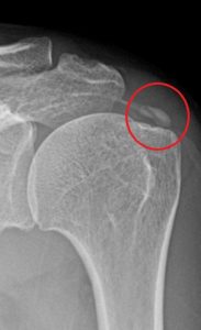 안양 고래한의원 - 어깨 석회화 건염01