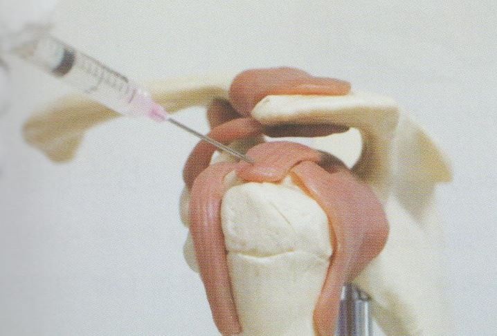 어깨 석회화 건염02