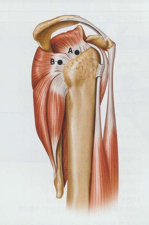 어깨 석회화 건염 4 어깨 석회화 건염03
