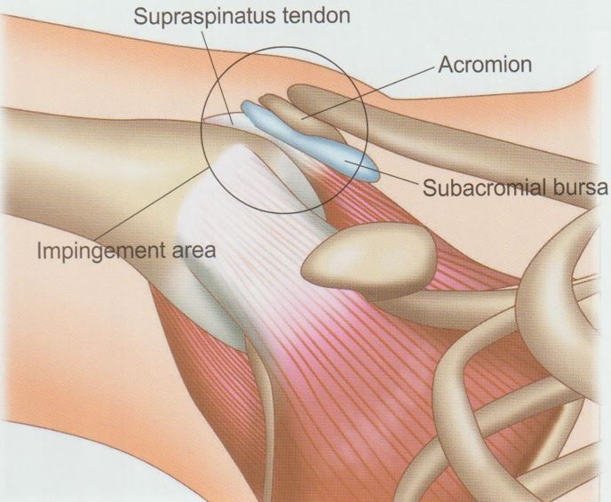 어깨충돌증후군02
