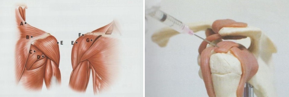 어깨충돌증후군03