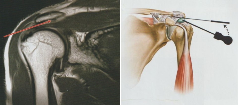 어깨충돌증후군04