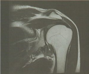 안양 고래한의원 - 오십견 동결견 유착성 관절낭염01