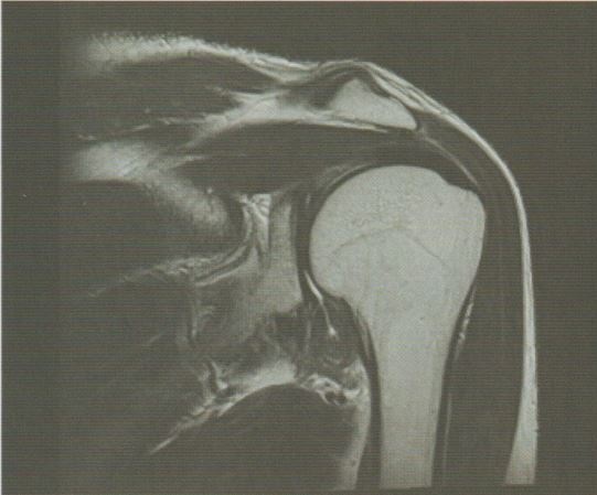 안양 고래한의원 - 오십견, 동결견 (유착성 관절낭염)