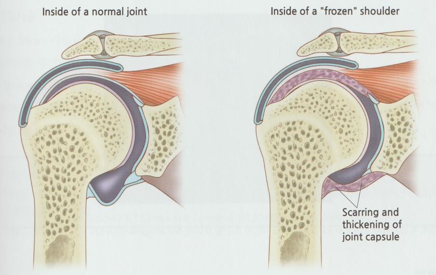 오십견 동결견 유착성 관절낭염02