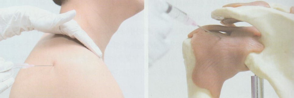 오십견 동결견 유착성 관절낭염04