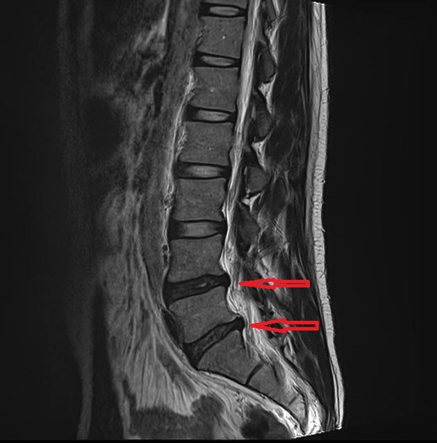 요추 추간판 탈출증 (요추 디스크) 2 요추 추간판 탈출증 요추 디스크01