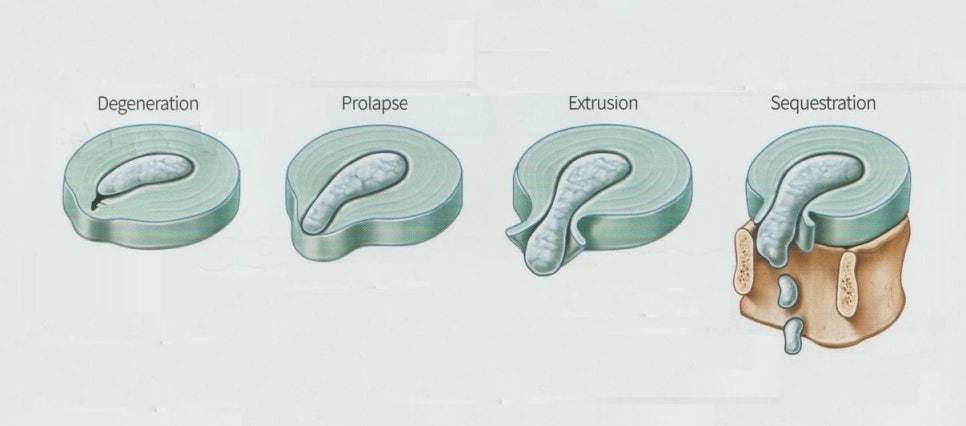 요추 추간판 탈출증 (요추 디스크) 4 요추 추간판 탈출증 요추 디스크04