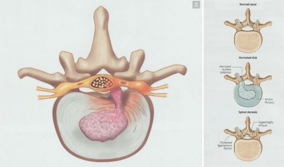 요추 추간판 탈출증 (요추 디스크) 5 요추 추간판 탈출증 요추 디스크05