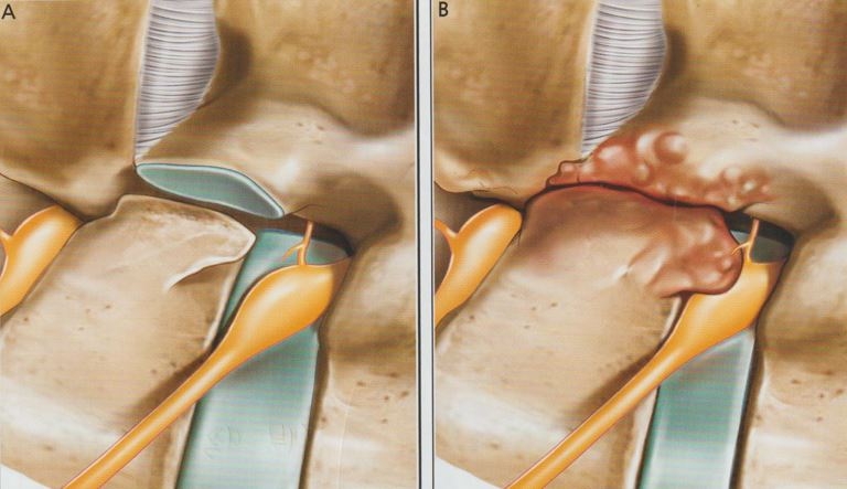 요추 후관절 증후군 4 요추 후관절 증후군04