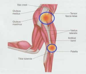안양 고래한의원 - 장경인대증후군001
