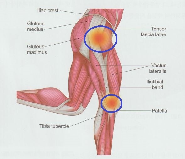 안양 고래한의원 - 장경인대증후군
