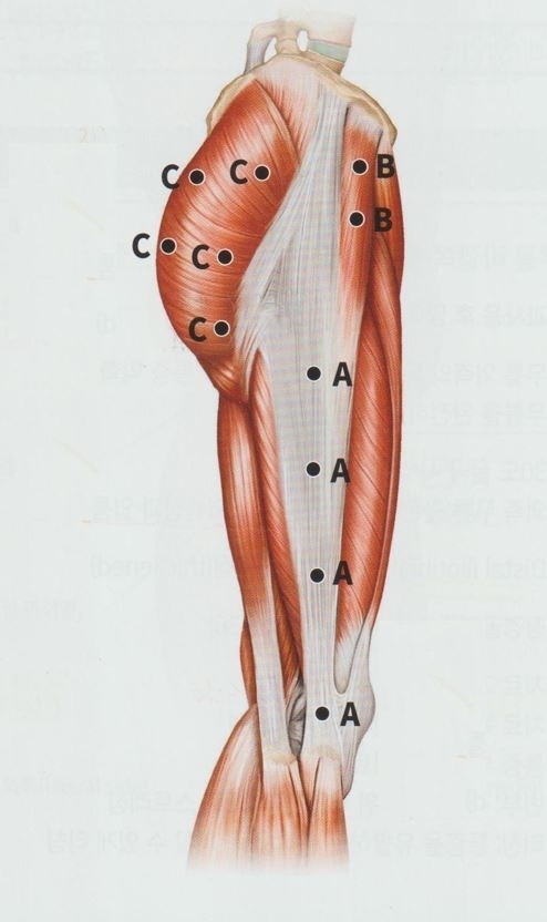 장경인대증후군002