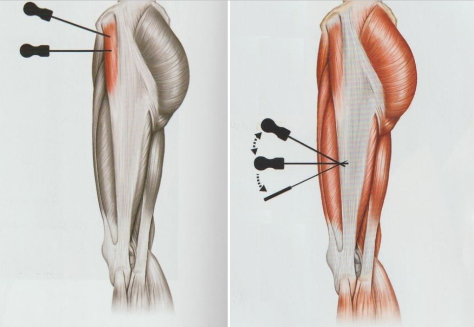 장경인대증후군003