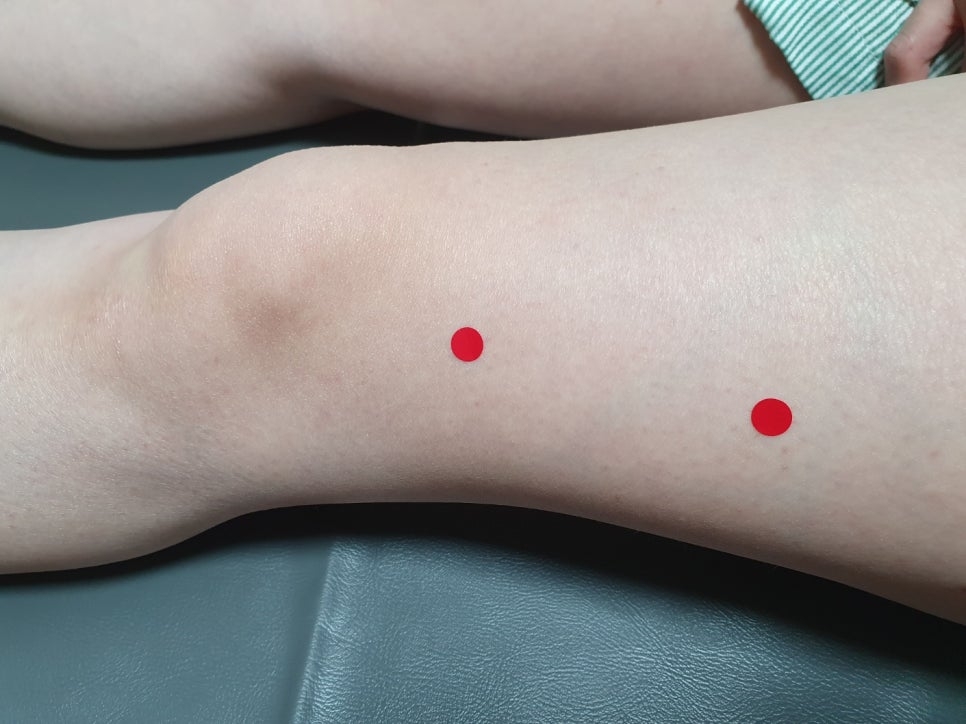 장경인대증후군004