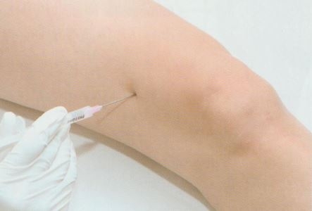 장경인대증후군005