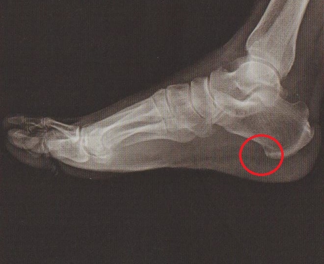 안양 고래한의원 - 족저근막염 (발바닥 근막염)