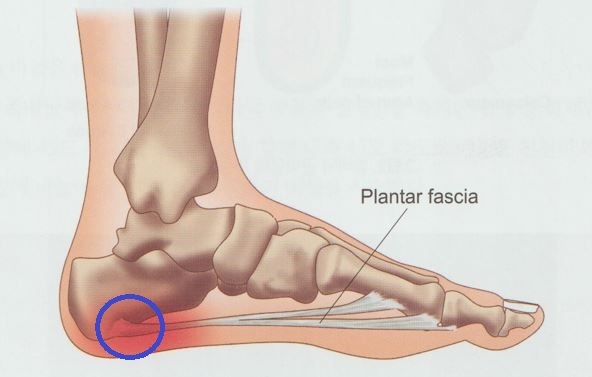 족저근막염002