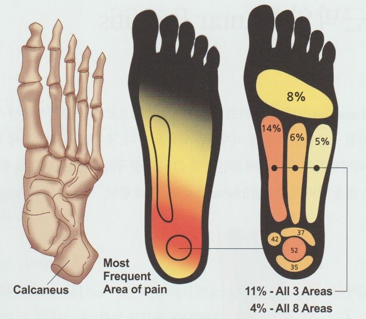 족저근막염003