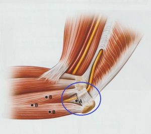 안양 고래한의원 - 주관 증후군 팔꿈치 터널 증후군01