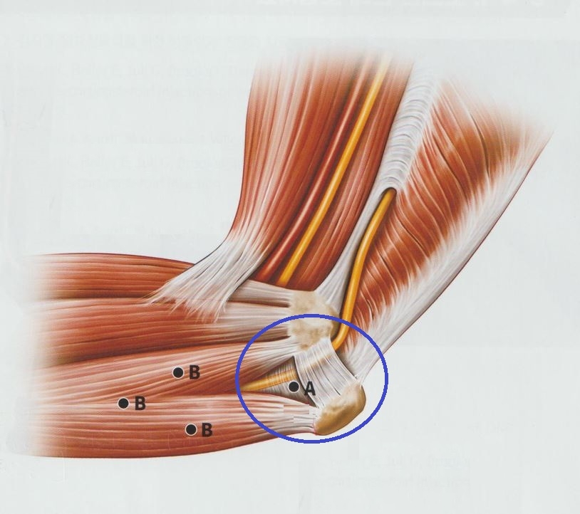 안양 고래한의원 - 주관 증후군 (팔꿈치 터널 증후군)