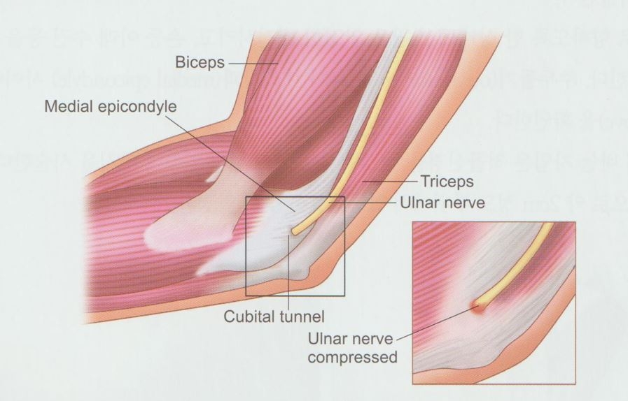 주관 증후군 팔꿈치 터널 증후군02