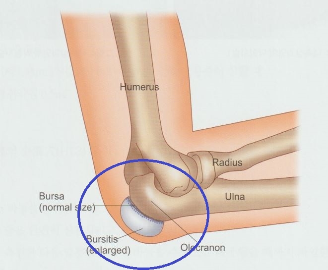 주두 점액낭염002