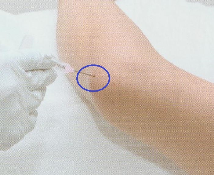 주두 점액낭염003