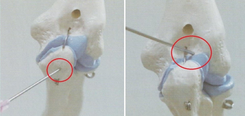 주두 점액낭염004