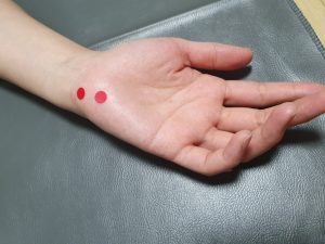 안양 고래한의원 - 척골관 증후군 가이온 증후군001 1