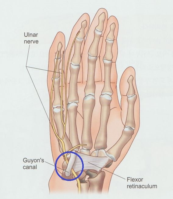 척골관 증후군 가이온 증후군002 1