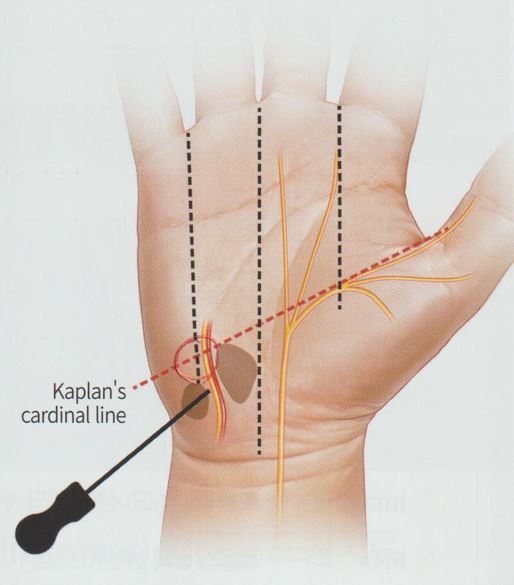 척골관 증후군 가이온 증후군003 1