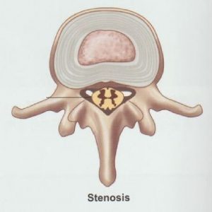 안양 고래한의원 - 척추관 협착증01