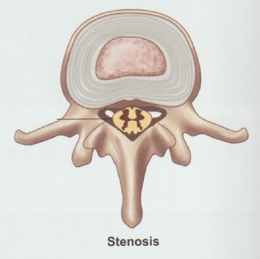 안양 고래한의원 - 척추관 협착증