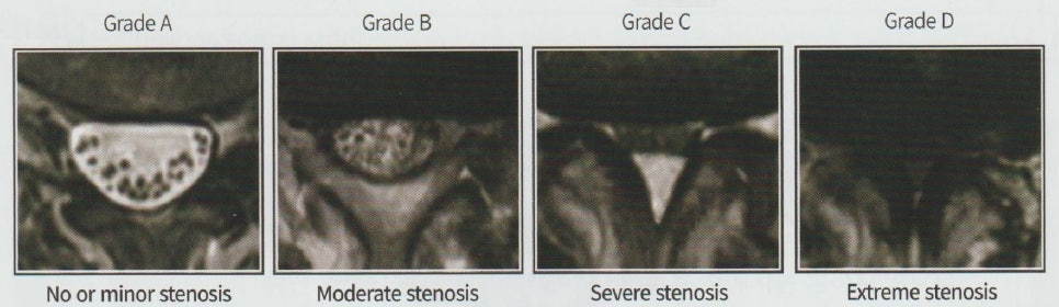 척추관 협착증04