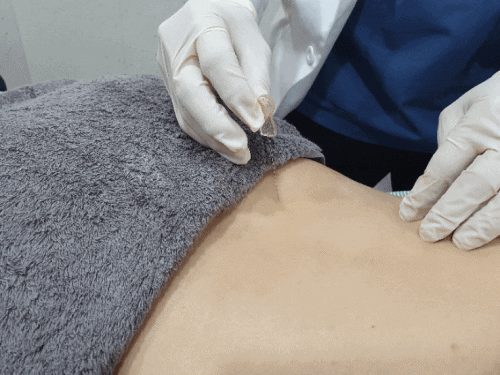 척추관 협착증6