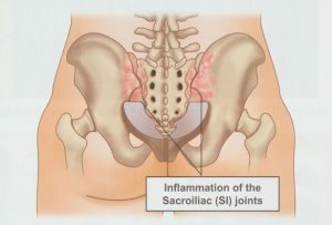 안양 고래한의원 - 천장관절증후군01