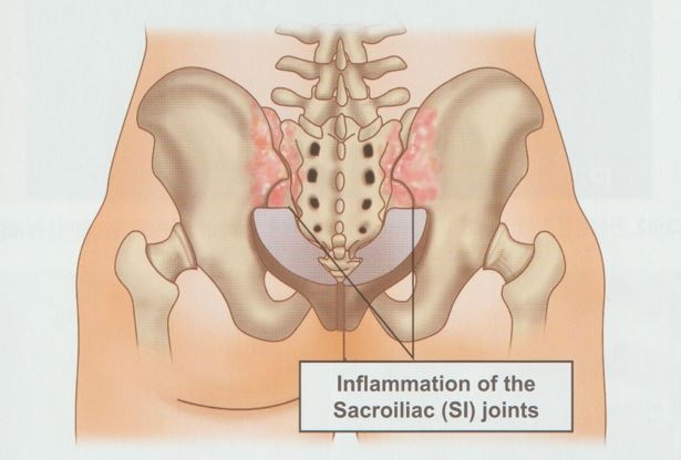 안양 고래한의원 - 천장관절 증후군