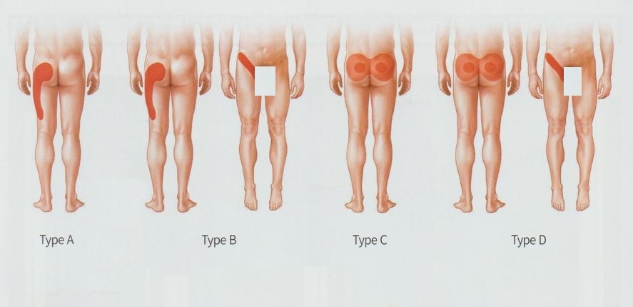 천장관절증후군02