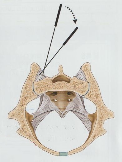 천장관절증후군03