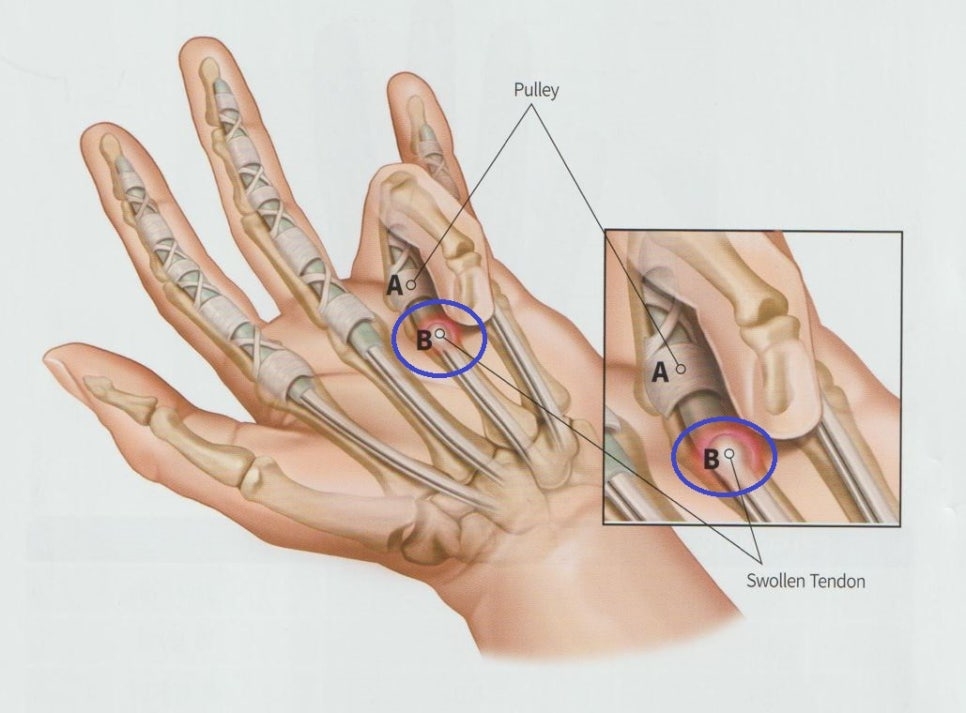안양 고래한의원 - 탄발지 (방아쇠 수지)