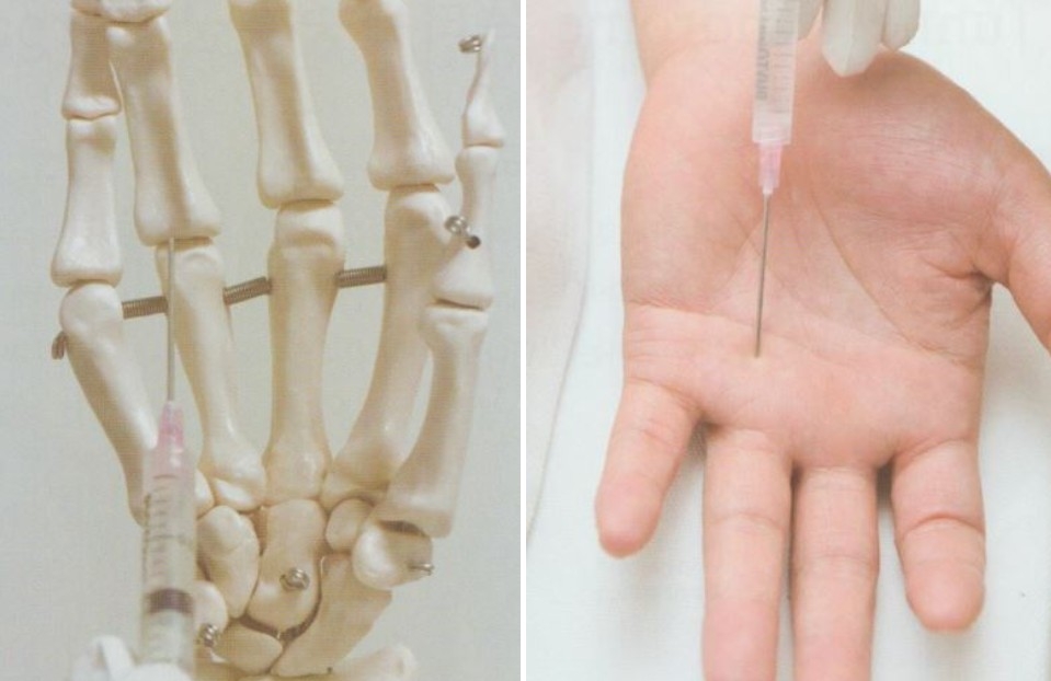 탄발지 방아쇠 수지003