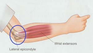 안양 고래한의원 - 테니스 엘보우 주관절 외상과염01