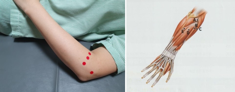 테니스 엘보우 주관절 외상과염02