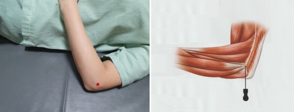 테니스 엘보우 주관절 외상과염03