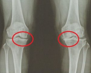 안양 고래한의원 - 퇴행성 무릎 골관절염001