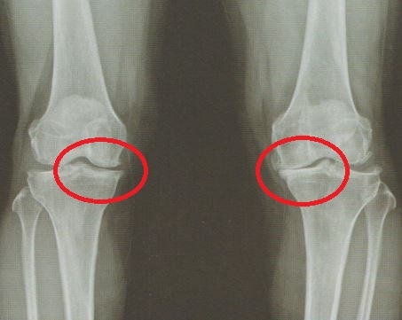 안양 고래한의원 - 퇴행성 무릎 골관절염 (퇴행성 슬관절염)